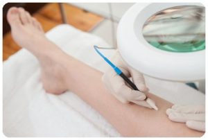 About Electrolysis for Permanent Hair Removal: Nicolsons ...